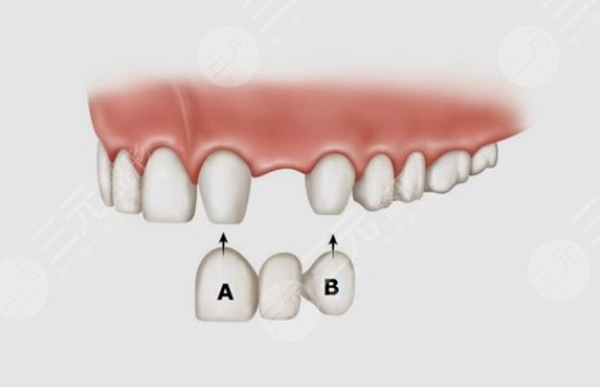 烤瓷牙面修復(fù)