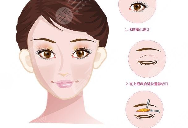 雙眼皮手術(shù)