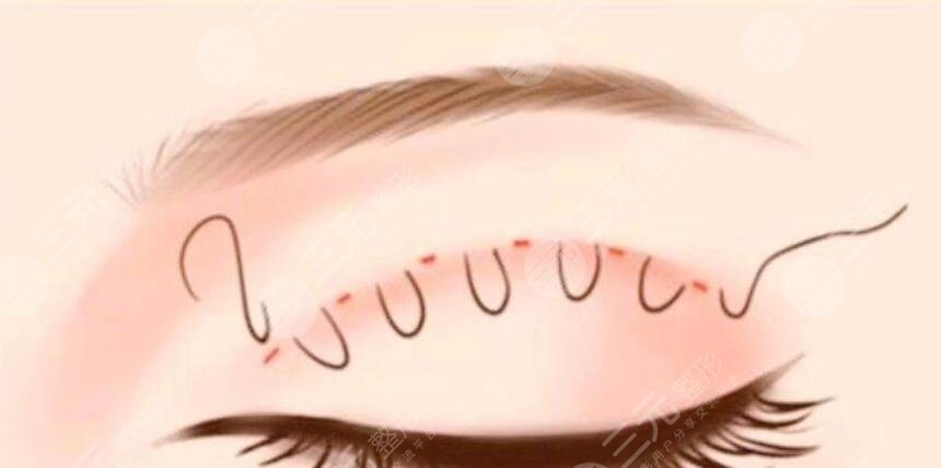 雙眼皮手術(shù)