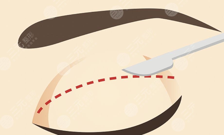 雙眼皮手術(shù)