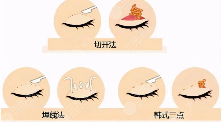 雙眼皮手術(shù)