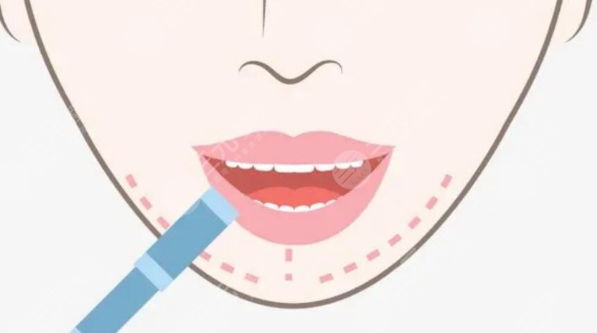 紋唇手術(shù)