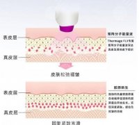 熱瑪吉和超聲炮哪個提升效果好？它們的區(qū)別有哪些?