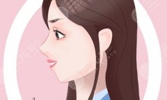 下巴頦成型多久恢復？術(shù)后會出現(xiàn)反彈現(xiàn)象嗎？