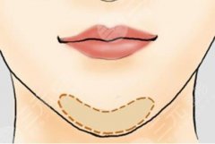 medpor墊下巴的優(yōu)缺點是什么？做完之后會不會出現(xiàn)感染的現(xiàn)象呢？