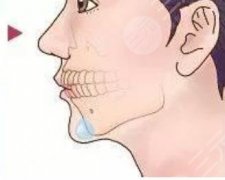 medpor墊下巴多久拆線？墊下巴可以改變凸嘴的現(xiàn)象嗎？