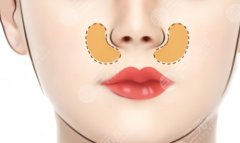 鼻基底凹陷填充用什么材料好？這幾種材料優(yōu)勢區(qū)別是什么？