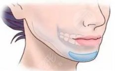 peek下巴會假嗎？填充下巴貴不貴？一般需要多少錢