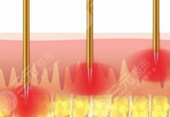 黃金微針的副作用和危害是什么？微針作用原理get！
