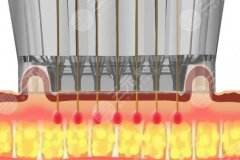 黃金微針腋臭效果好嗎？微針會(huì)不會(huì)促使皮膚角質(zhì)層變薄呢？