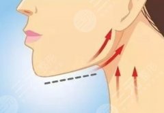 peek修復下頜骨是永久的嗎？可以面部哪些問題？