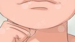 peek能填充下巴是永久的嗎？效果到底好不好呢？