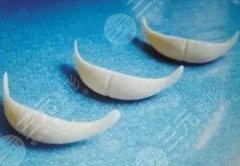 medpor下巴假體缺點是什么？隆下巴可以維持很久嗎?