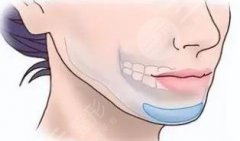 medpor下巴假體怎么樣？下巴整形除了假體有其他選擇嗎？