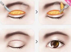 雙眼皮修復(fù)三個(gè)月可以再次修復(fù)嗎？手術(shù)失敗的原因有哪些呢？
