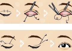 雙眼皮修復(fù)適宜時(shí)間是什么時(shí)候？眼部出現(xiàn)哪些問題需要修復(fù)？