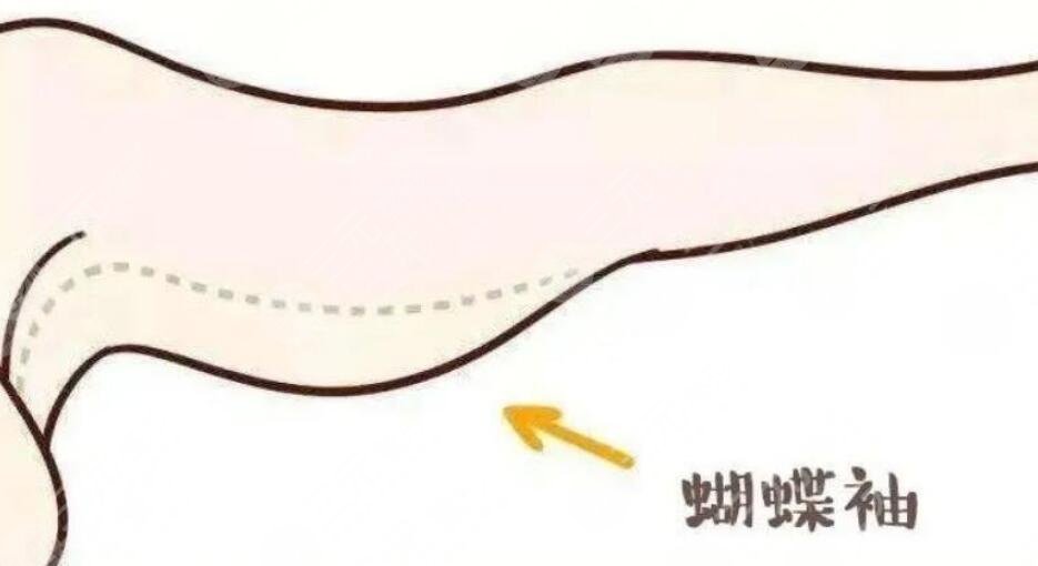 蝴蝶袖吸脂