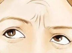 填充川字紋能保持多長時間？填充手術是如何操作的？