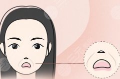 填充法令紋用什么填充比較好？填充后通?？梢跃S持多長時間？