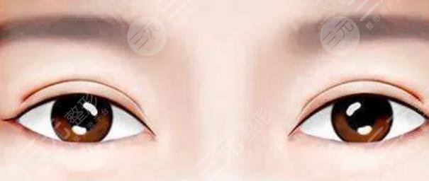 雙眼皮