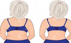 背部吸脂后疼嗎？恢復(fù)期是多久？術(shù)后注意事項(xiàng)盤點(diǎn)！