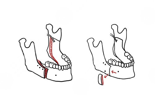 蘇大附一院正頜手術價格