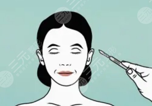 黃寅守做60歲以上的拉皮效果