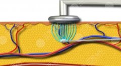 bodytite射頻溶脂術(shù)后腫幾天？射頻溶脂適合哪些部位？