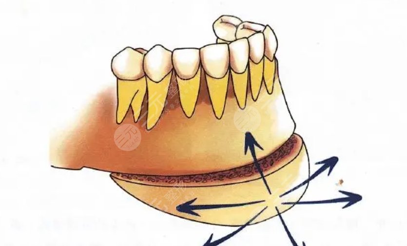頦成型手術(shù)