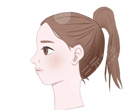 頦成型手術(shù)