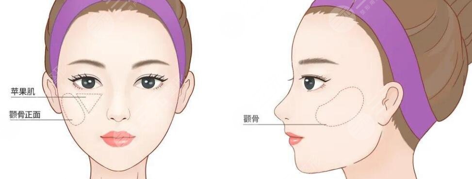 顴骨內(nèi)推
