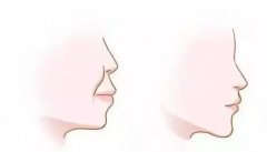 凸嘴矯正后鼻子會(huì)不會(huì)變挺？來(lái)看原理就知道了！流程一覽