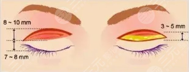 雙眼皮修復(fù)