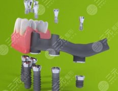 瑞士iti種植牙多少錢一顆？有什么型號(hào)嗎？看完再?zèng)Q定