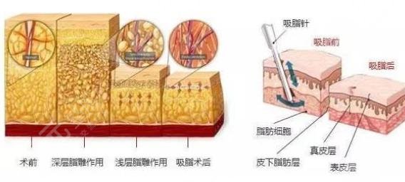 面部吸脂