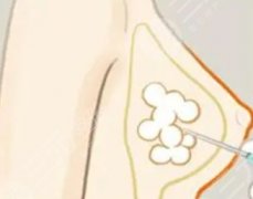 取隆胸假體從哪里切口好？術(shù)后多久可以恢復(fù)呢？