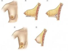 胸下垂做手術(shù)大概需要多少錢？胸下垂手術(shù)后的注意事項(xiàng)分享！