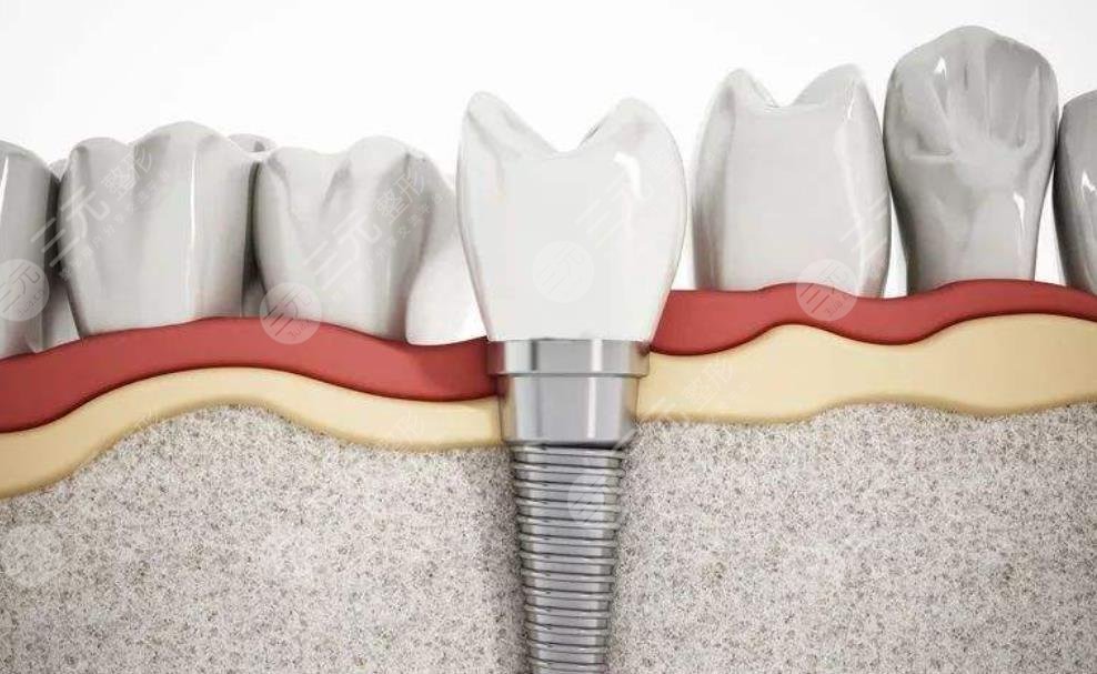 牙齒種植