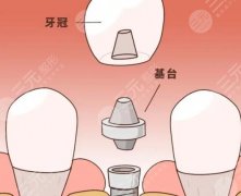 天津市口腔醫(yī)院種植牙多少錢一顆？2025項(xiàng)目收費(fèi)表出爐！