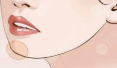 下巴發(fā)育過(guò)度頦成型整形手術(shù)有用嗎？術(shù)后多久可以消腫