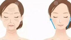 輪廓固定是什么項(xiàng)目？輪廓固定與面部填充有哪些區(qū)別？