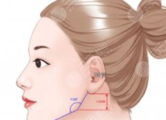下頜線輪廓不清晰怎么？輪廓提升術(shù)后的護(hù)理小技巧有哪些？