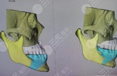 頦成型幾天可以正常吃東西？除飲食之外還有哪些需要注意呢？