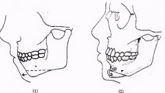 正畸正頜聯(lián)合好不好？手術(shù)流程是怎么樣的？