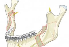 正頜手術(shù)有必要做嗎？正頜手術(shù)階段要做些什么？