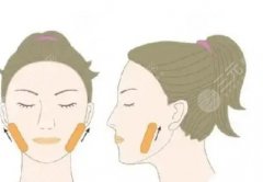 開(kāi)頜不矯正會(huì)怎么樣？矯正方法推薦|術(shù)后如何護(hù)理