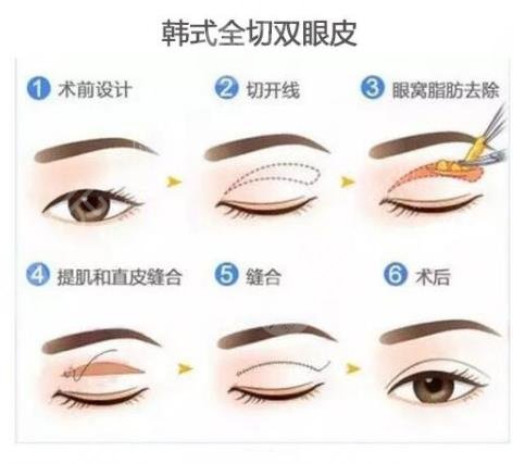 全切雙眼皮