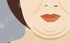 雙下巴吸脂多少錢？價格貴不貴？技術(shù)優(yōu)勢點評！