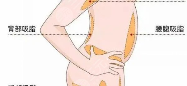 吸脂