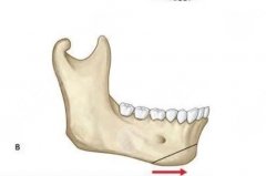 頦成型手術(shù)風(fēng)險(xiǎn)大嗎？頦成形術(shù)的手術(shù)并發(fā)癥及處理方式介紹！